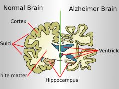 Indian study finds potential new Alzheimer’s disease biomarker