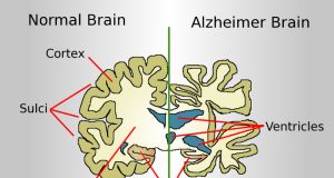Indian study finds potential new Alzheimer’s disease biomarker