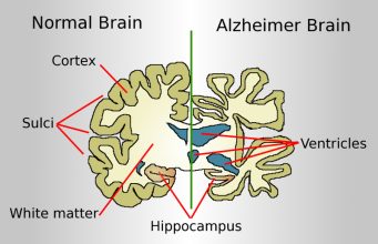 Indian study finds potential new Alzheimer’s disease biomarker