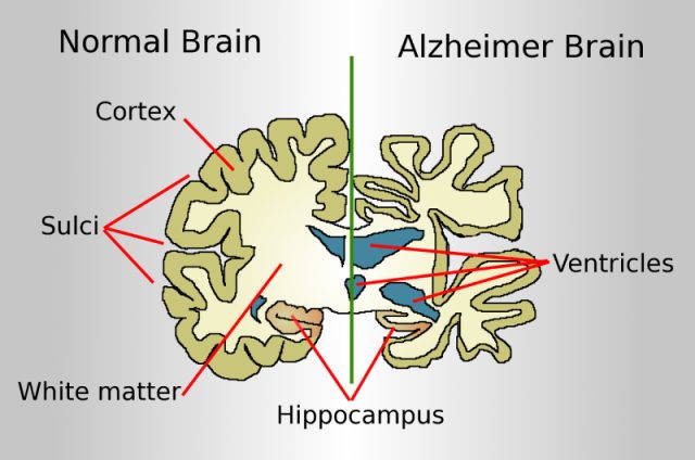 Indian study finds potential new Alzheimer’s disease biomarker