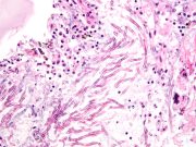 Fungal disease revealed to be a large scale threat to Indian health