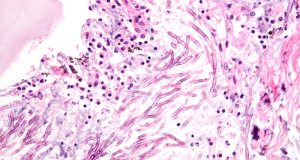 Fungal disease revealed to be a large scale threat to Indian health