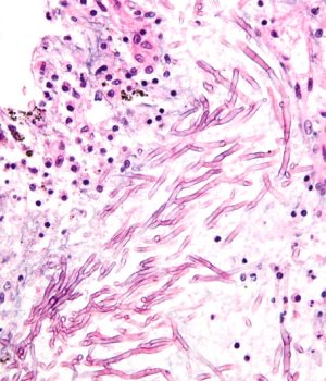 Fungal disease revealed to be a large scale threat to Indian health