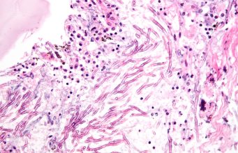 Fungal disease revealed to be a large scale threat to Indian health