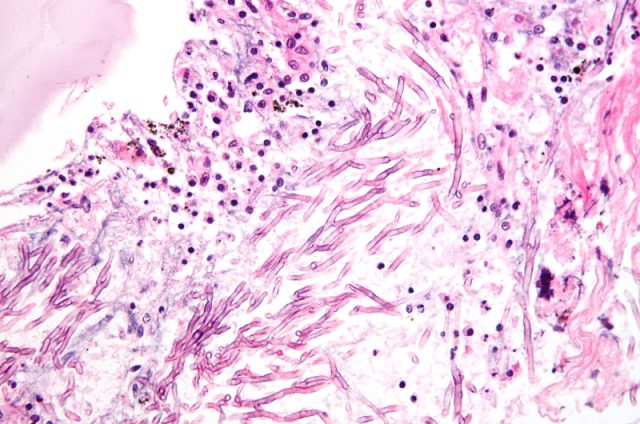 Fungal disease revealed to be a large scale threat to Indian health