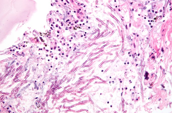 Fungal disease revealed to be a large scale threat to Indian health